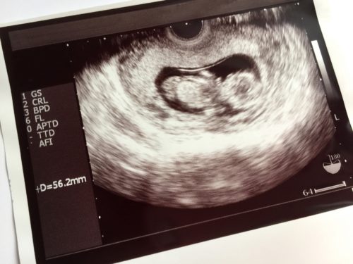 妊娠11週頃のエコー写真